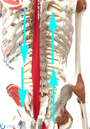 Bandscheibenmaterial hat sich in den Spinalkanal (Wirbelzwischenraum) gedrückt