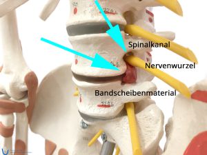 Bandscheibenmaterial hat sich in den Spinalkanal (Wirbelzwischenraum) gedrückt 